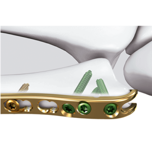 LCP Distal Ulna Plate