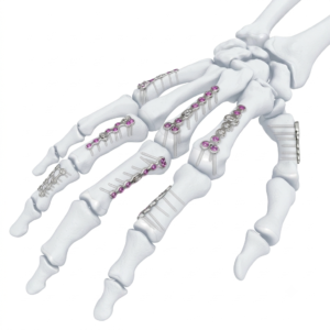 Variable Angle Locking Hand System